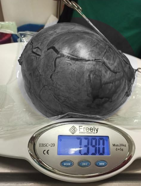 Karnından 7 Kilo 390 Gram Kitle Çıkarıldı