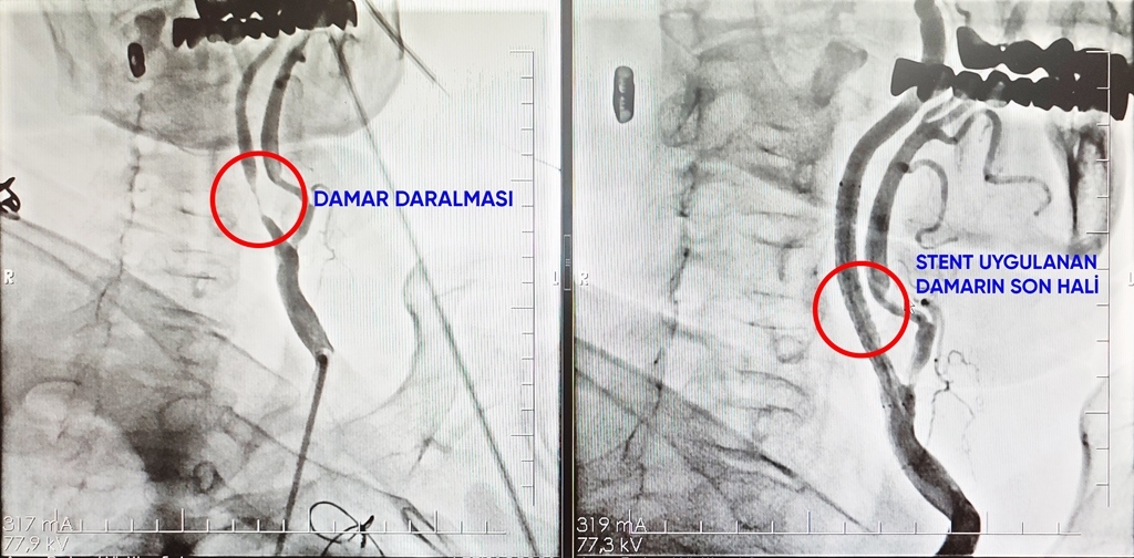 PARKHAYAT HASTANESİ'NDEN BAŞARILI OPERASYON!