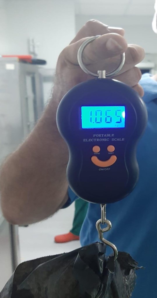 MESANESİNDEN 1 KİLOGRAMLIK TAŞ ÇIKARILDI