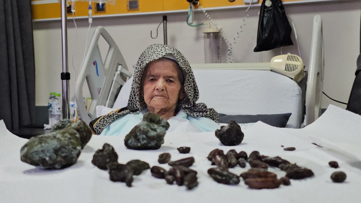 Görenler Şok Oldu: 92 Yaşındaki Kadının Midesinden ve Bağırsaklarından 35 Zeytin, 28 Hurma Çekirdeği İle 5 Taş Çıktı