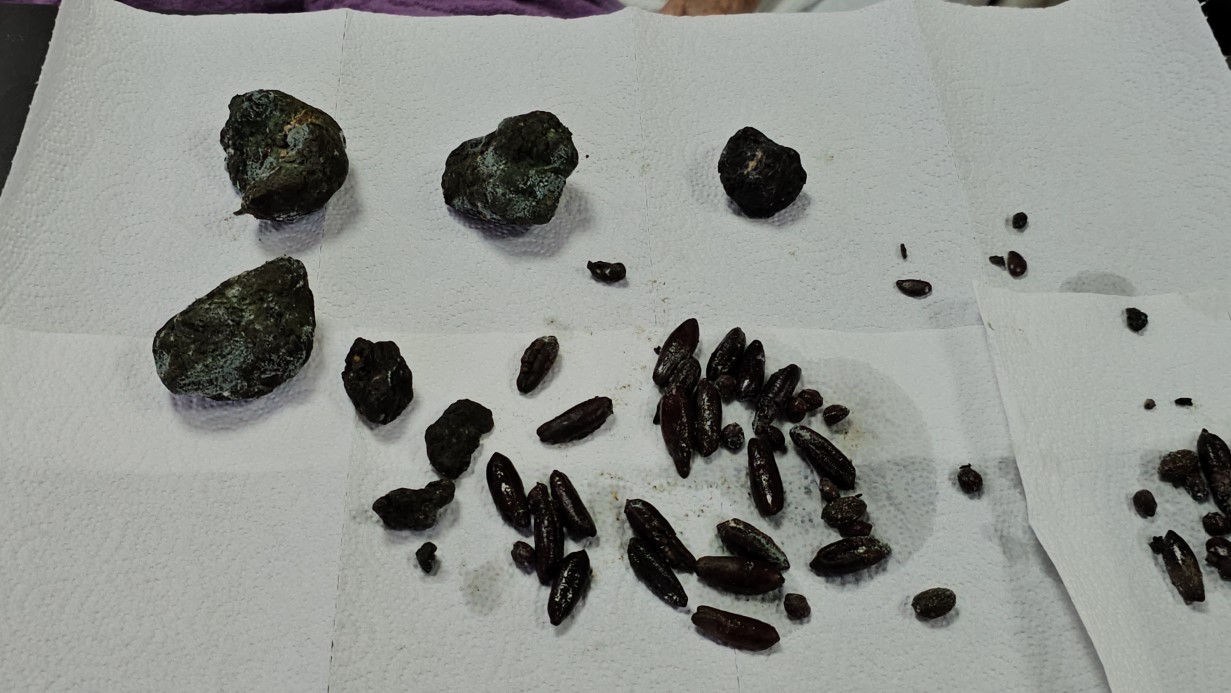 Görenler Şok Oldu: 92 Yaşındaki Kadının Midesinden ve Bağırsaklarından 35 Zeytin, 28 Hurma Çekirdeği İle 5 Taş Çıktı