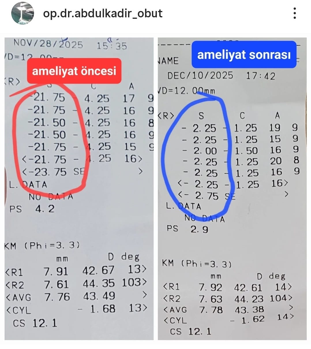 55 Yıllık Hasret Sona Erdi: 21 Numaralı Gözlükten Kurtuldu!