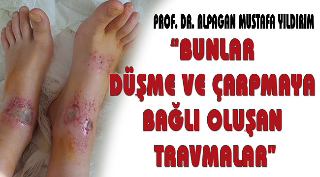 “BUNLAR DÜŞME VE ÇARPMAYA BAĞLI TRAVMALAR”