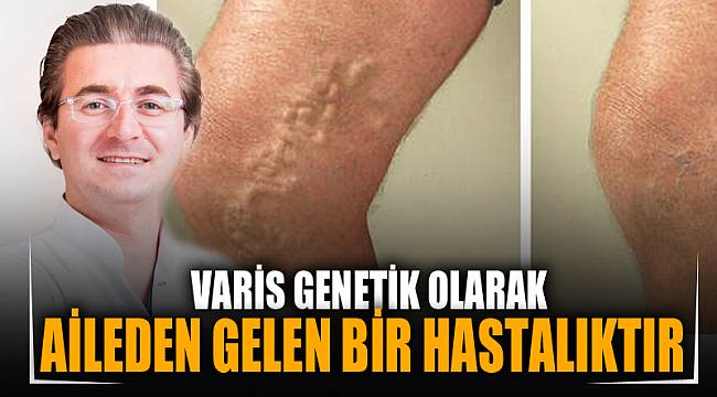 VARİS GENETİK OLARAK AİLEDEN GELEN BİR HASTALIKTIR