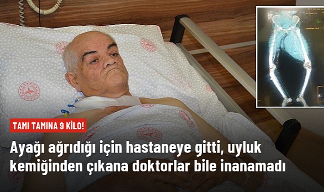AYAĞI AĞRIDIĞI İÇİN HASTANEYE GİTTİ, UYLUK KEMİĞİNDEN ÇIKANA DOKTORLAR BİLE İNANAMADI
