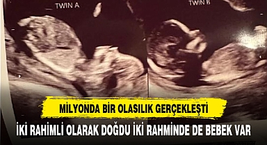 Milyonda bir olasılık gerçekleşti iki rahimli kadının...