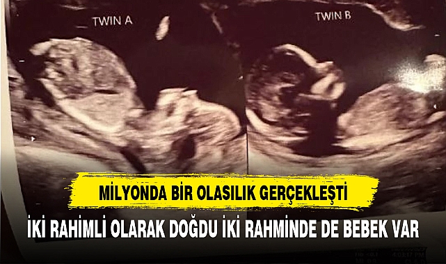 Milyonda bir olasılık gerçekleşti iki rahimli kadının...