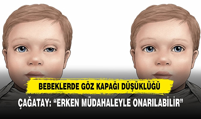 Bebeklerde Göz Kapağı Düşüklüğü