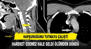 Hapşırığını tutmaya çalışan adamın boğazı patladı