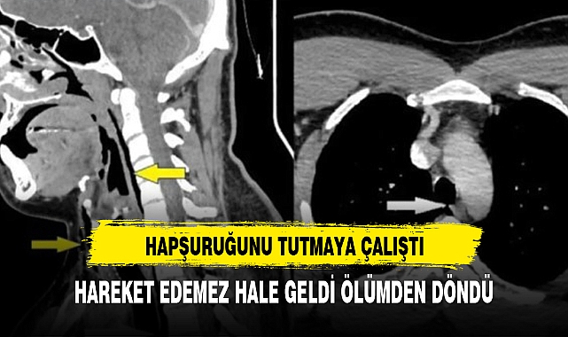 Hapşırığını tutmaya çalışan adamın boğazı patladı