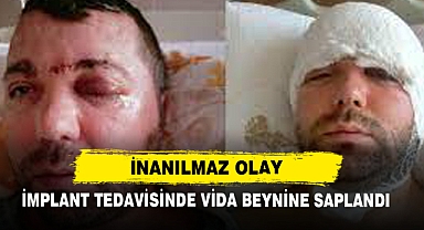 İnanılmaz Olay: İmplant Tedavisinde Vida Beynine Saplandı