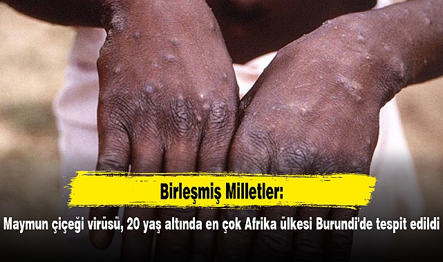 BM: Maymun çiçeği virüsü, 20 yaş altında en çok Afrika ülkesi Burundi'de tespit edildi