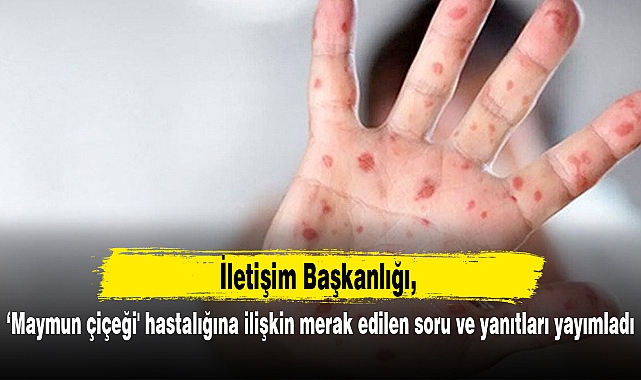 İletişim Başkanlığı, 'maymun çiçeği' hastalığına ilişkin merak edilen soru ve yanıtları yayımladı