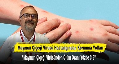 Maymun Çiçeği Virüsü Hastalığından Korunma Yolları