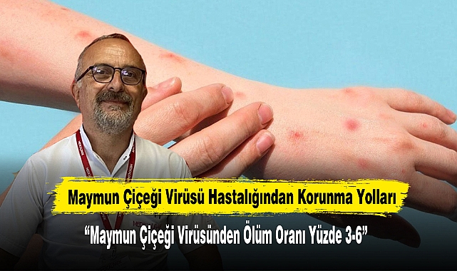 Maymun Çiçeği Virüsü Hastalığından Korunma Yolları