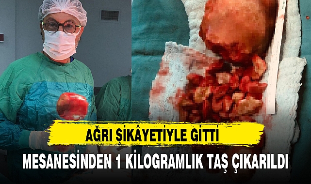 MESANESİNDEN 1 KİLOGRAMLIK TAŞ ÇIKARILDI