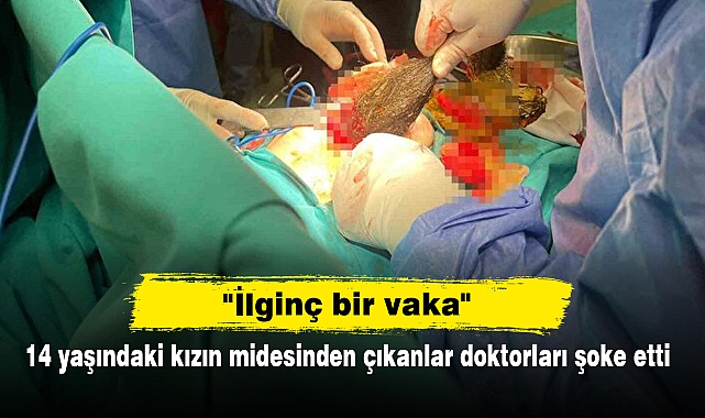 14 yaşındaki kızın midesinden çıkanlar doktorları şoke etti
