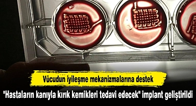 "Hastaların kanıyla kırık kemikleri tedavi edecek" implant geliştirildi