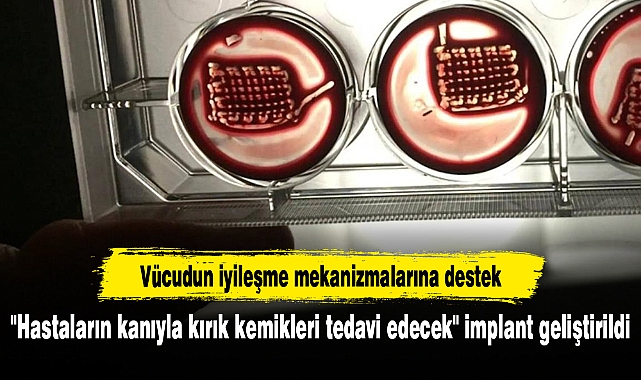 "Hastaların kanıyla kırık kemikleri tedavi edecek" implant geliştirildi