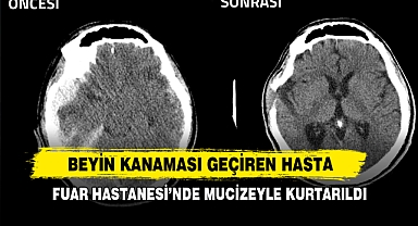 Beyin Kanaması Geçiren Hasta Fuar Hastanesi’nde Mucizeyle Kurtarıldı