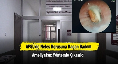 AFSÜ'de Nefes Borusuna Kaçan Badem Ameliyatsız Yöntemle Çıkarıldı