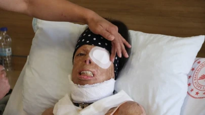 Kezzap Genç Kadının Hayatını Kararttı