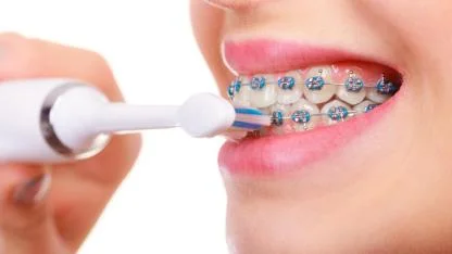 AFSÜ’lü Bilim İnsanları Kanıtladı: Şarjlı Diş Fırçaları Diş Teli Kullananlarda 2 Kat Daha Etkili!