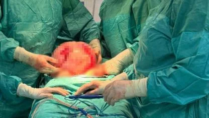 Karnı 2 Ayda 9 Aylık Hamile Gibi Büyüdü: 8,5 Kiloluk Kitle Çıkarıldı!