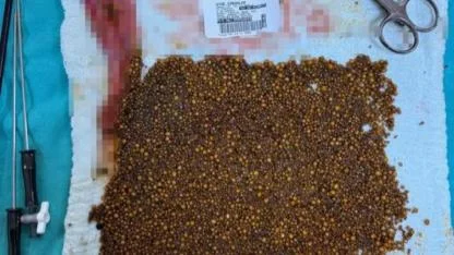 Safra Kesesinden 20 Bin Taş Çıktı!