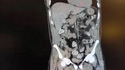 Fas’tan Türkiye’ye Midesinde 49 Kapsül Esrar Getirdi!