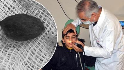 Kahramanmaraş’ta Otizmli Çocuğun Burnundan Zeytin Çekirdeği Ve Pipet Çıktı