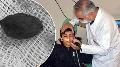 Kahramanmaraş’ta Otizmli Çocuğun Burnundan Zeytin Çekirdeği Ve Pipet Çıktı