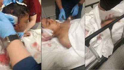 Ankara’da Sokak Köpeğinin Saldırısına Uğrayan Çocuk Yaralandı