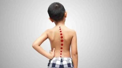 Çocuklarda Skolyoz Tehlikesi: Erken Tanı Büyük Önem Taşıyor