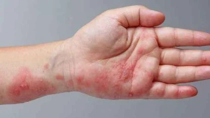 50 Yaş Üstüne Hayati Uyarı: Çocuklukta Bulaşan Zona Hastalığı Yıllar Sonra Uyanabiliyor!