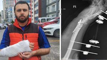 Sahipsiz köpeklerin saldırısından kaçmak isterken bileği kırıldı