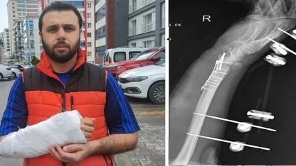 Sahipsiz köpeklerin saldırısından kaçmak isterken bileği kırıldı