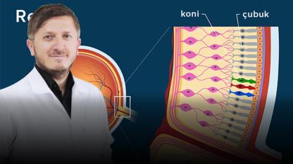 “Anı Işık Çakması Ve Uçuşmalar Retina Yırtığının Habercisi Olabilir”