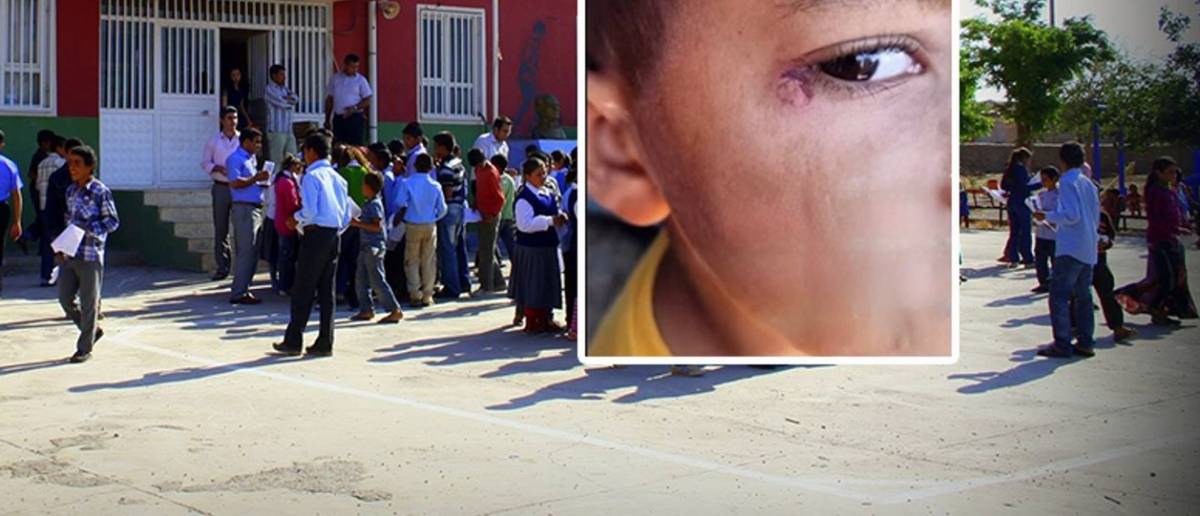 Şanlıurfa’da Skandal: Okulda Çocuğun Yüzünde Sigara Söndürüldü!