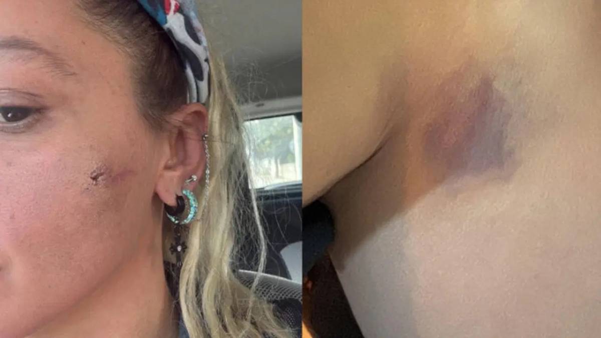 Yıldız Asyalı Eşi Semih Demirci Tarafından Darp Edildiğini Açıkladı!