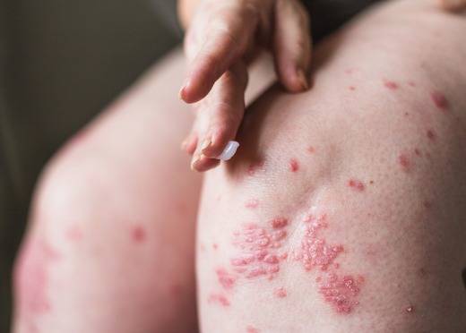 50 Yaş Üstüne Hayati Uyarı: Çocuklukta Bulaşan Zona Hastalığı Yıllar Sonra Uyanabiliyor!