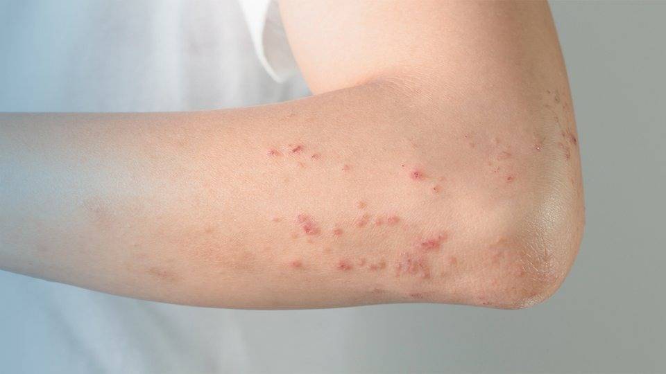 50 Yaş Üstüne Hayati Uyarı: Çocuklukta Bulaşan Zona Hastalığı Yıllar Sonra Uyanabiliyor!