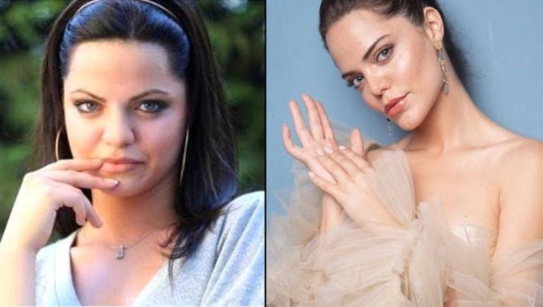 Hilal Altınbilek Ne Estetiği Yaptırdı?